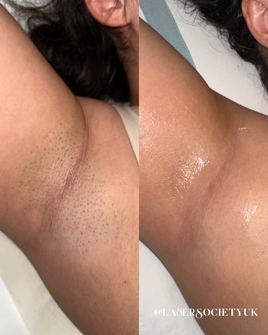 Laser hair removal treatment in Cheltenham clinic