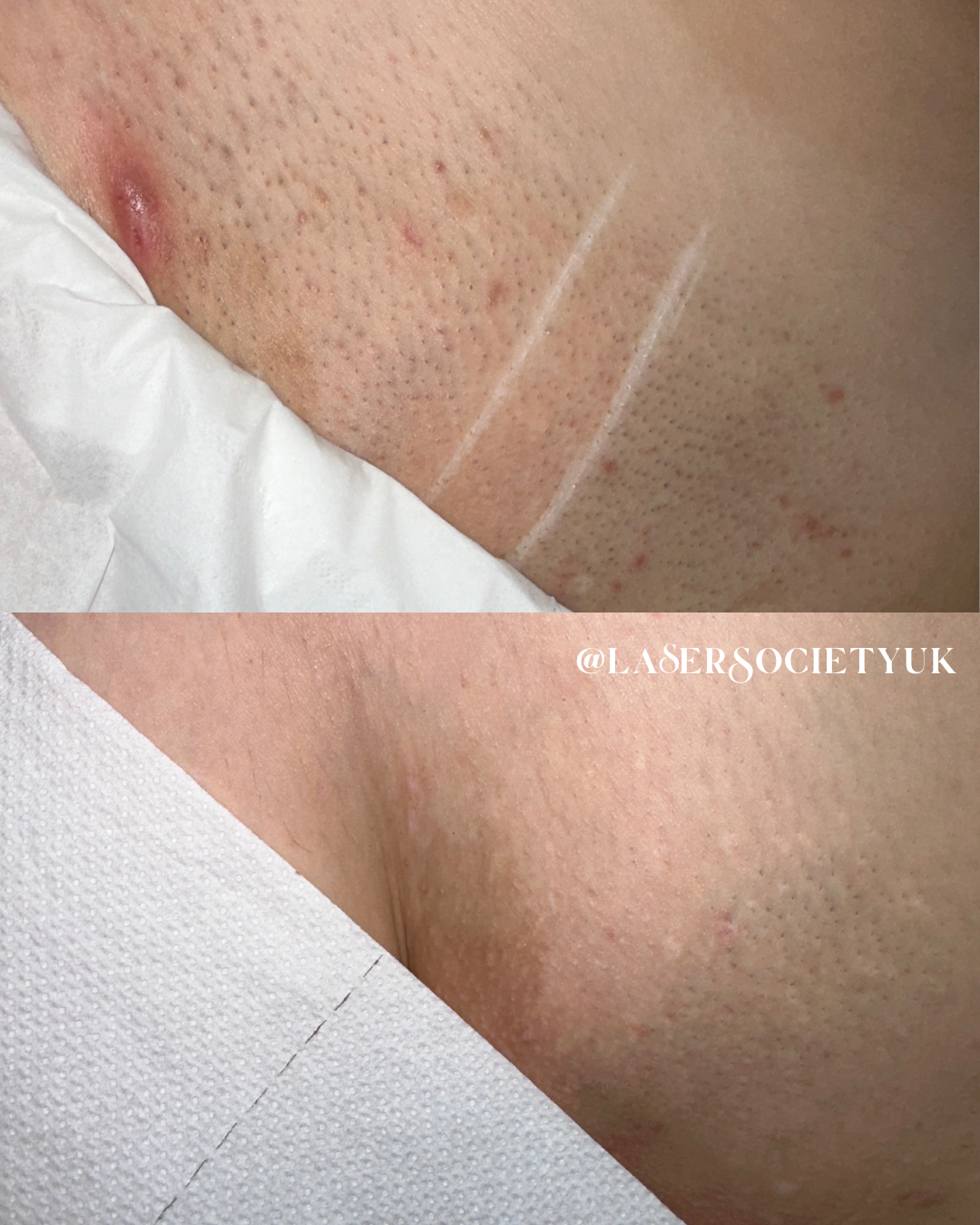 Laser hair removal treatment in Cheltenham clinic