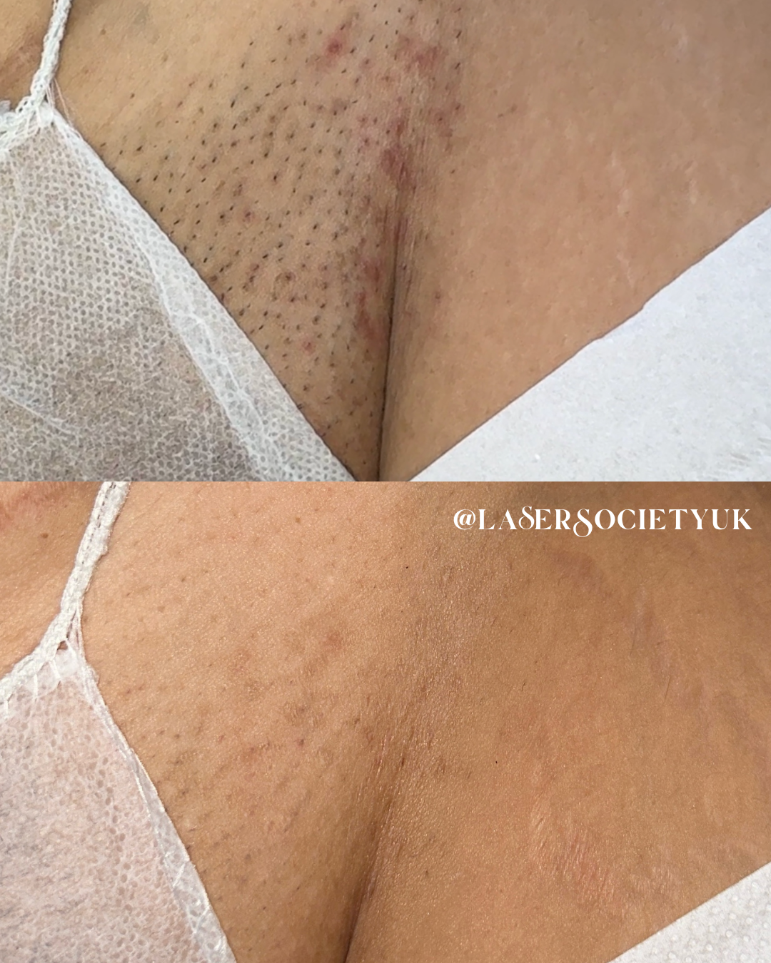 Laser hair removal treatment in Cheltenham clinic