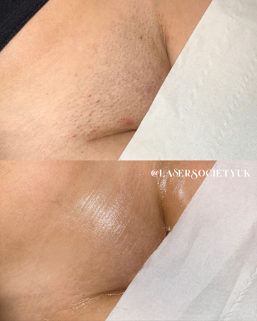 Laser hair removal treatment in Cheltenham clinic