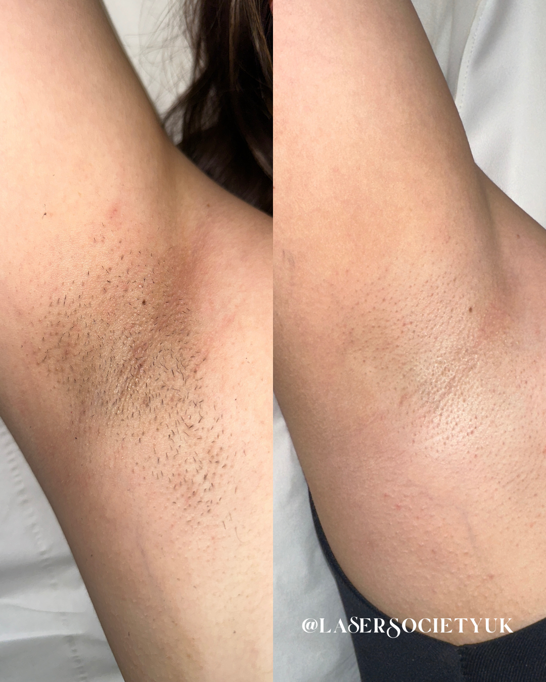 Laser hair removal treatment in Cheltenham clinic