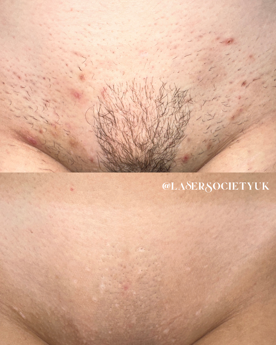 Laser hair removal treatment in Cheltenham clinic