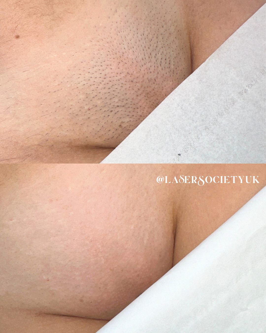 Laser hair removal treatment in Cheltenham clinic