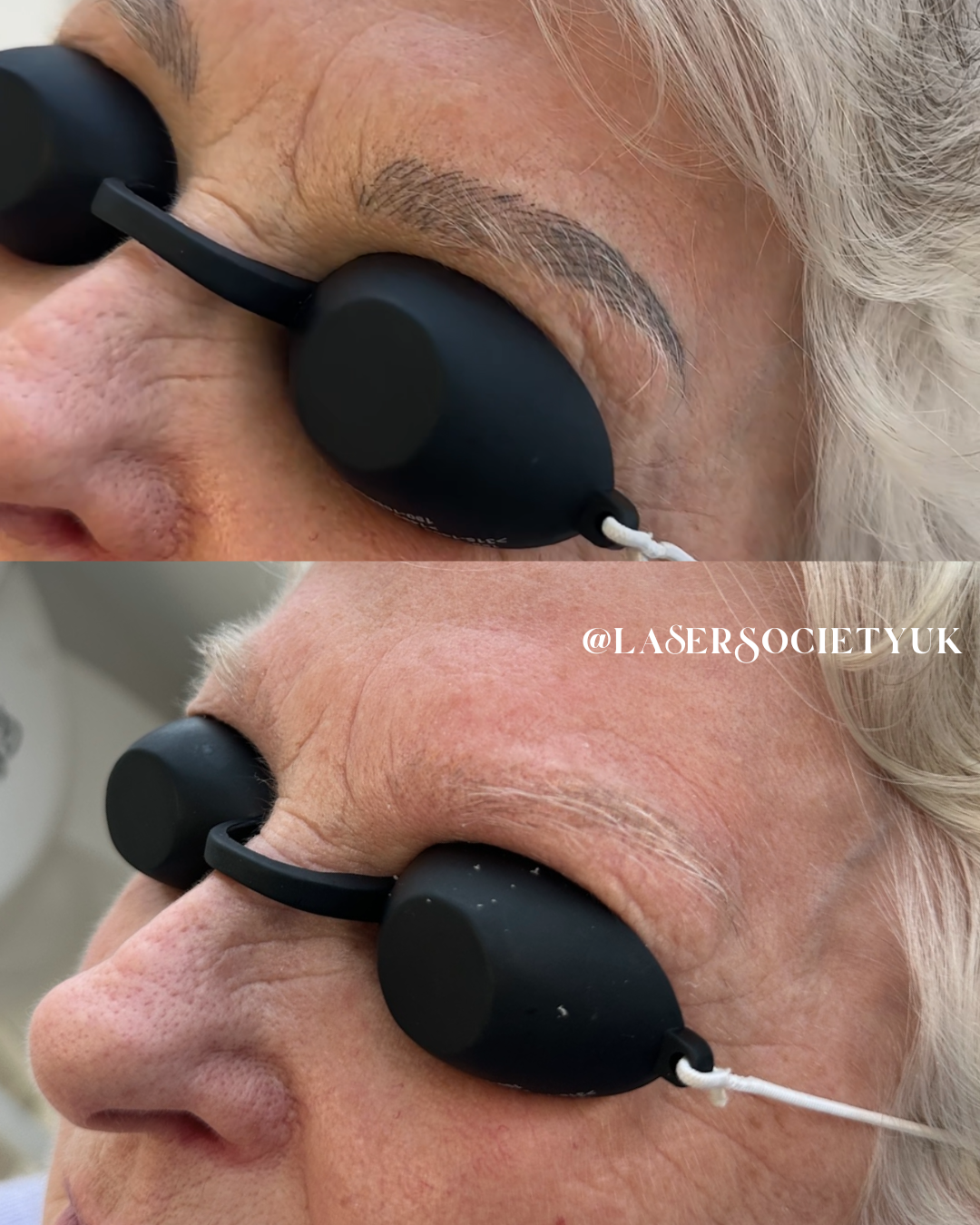 Close-up of a woman receiving removal of old semi permanent makeup removal treatment with protective eye shields in an spa or dermatology clinic.