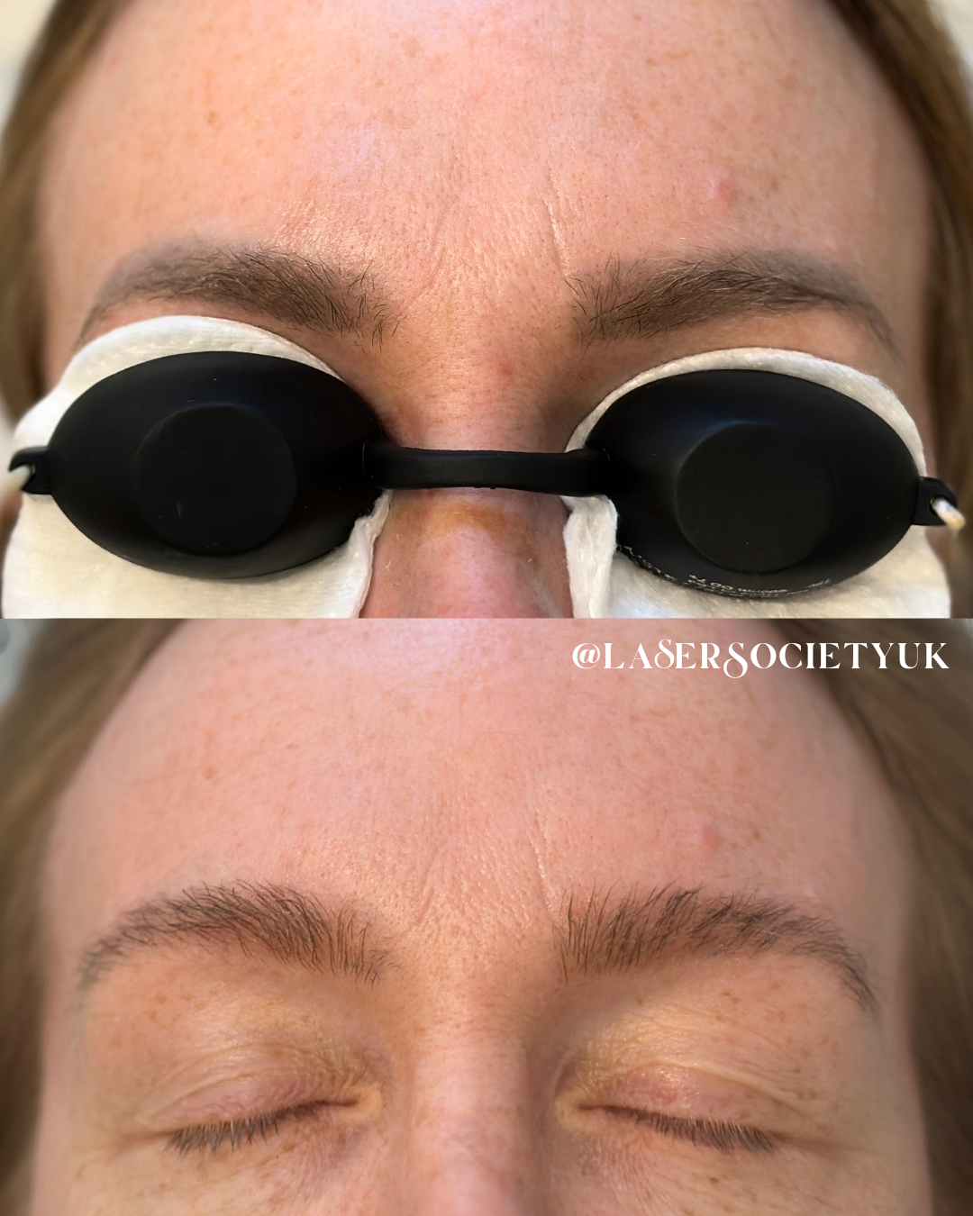 Close-up of a woman receiving removal of old semi permanent makeup removal treatment with protective eye shields in an spa or dermatology clinic.