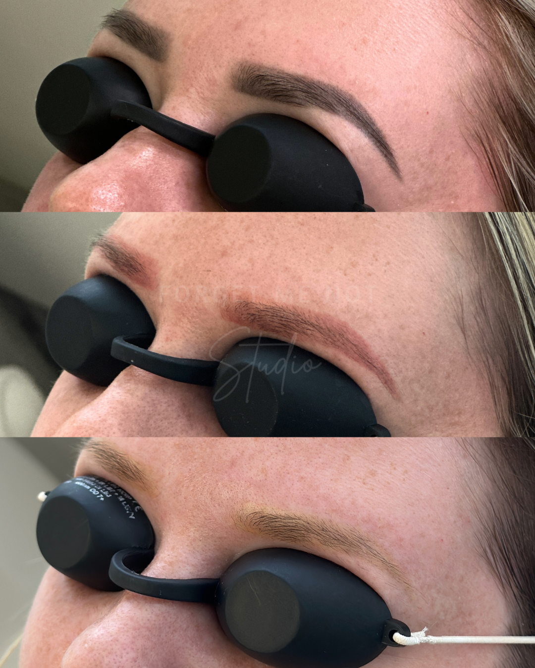 Close-up of a woman receiving removal of old semi permanent makeup removal treatment with protective eye shields in an spa or dermatology clinic.