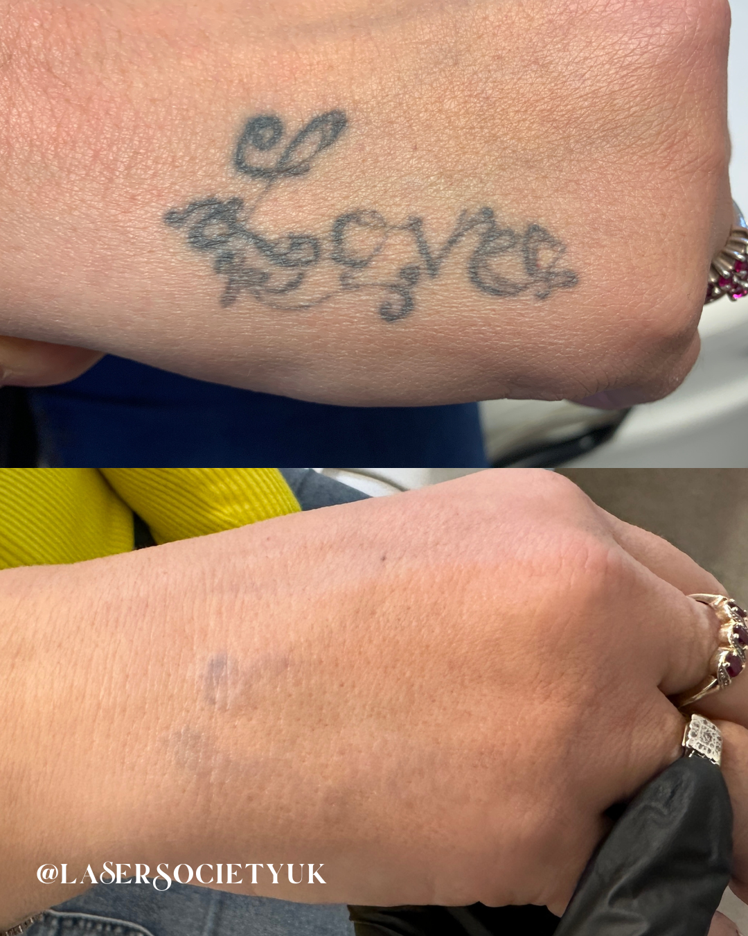 Comparison of two tattoos on hands, showing a faded tattoo with the word 'love' in cursive on the top and a nearly removed tattoo on the bottom with the text '@LASERSOCIETYUK' visible.