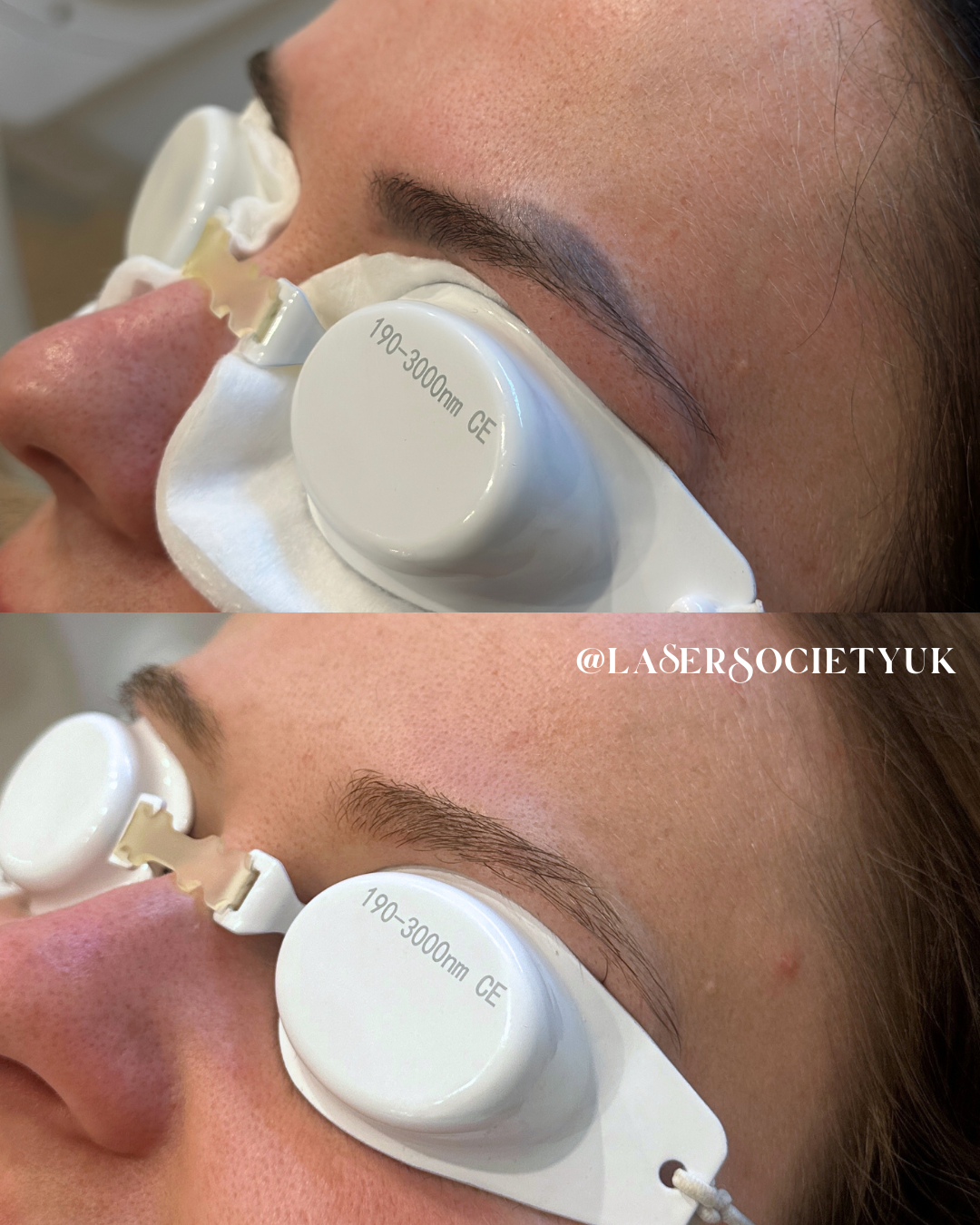 Close-up of a woman receiving removal of old semi permanent makeup removal treatment with protective eye shields in an spa or dermatology clinic.