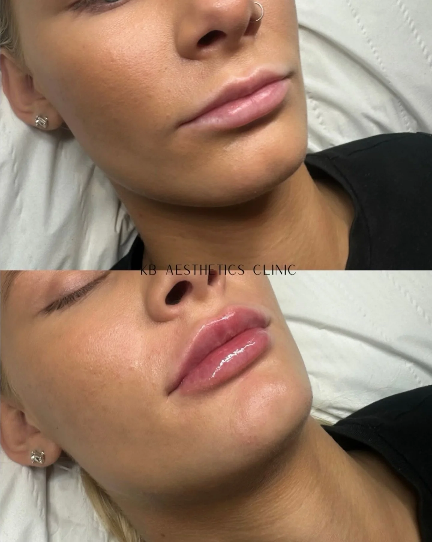 1ml Lip Filler for soft, natural enhancement and a perfectly shaped lips.💞

If you haven&rsquo;t booked your pre-Christmas appointment yet, now&rsquo;s the time.
DM @kbaestheticsclinic_ directly to secure your space. ✨

#fillercheltenham #aesthetics