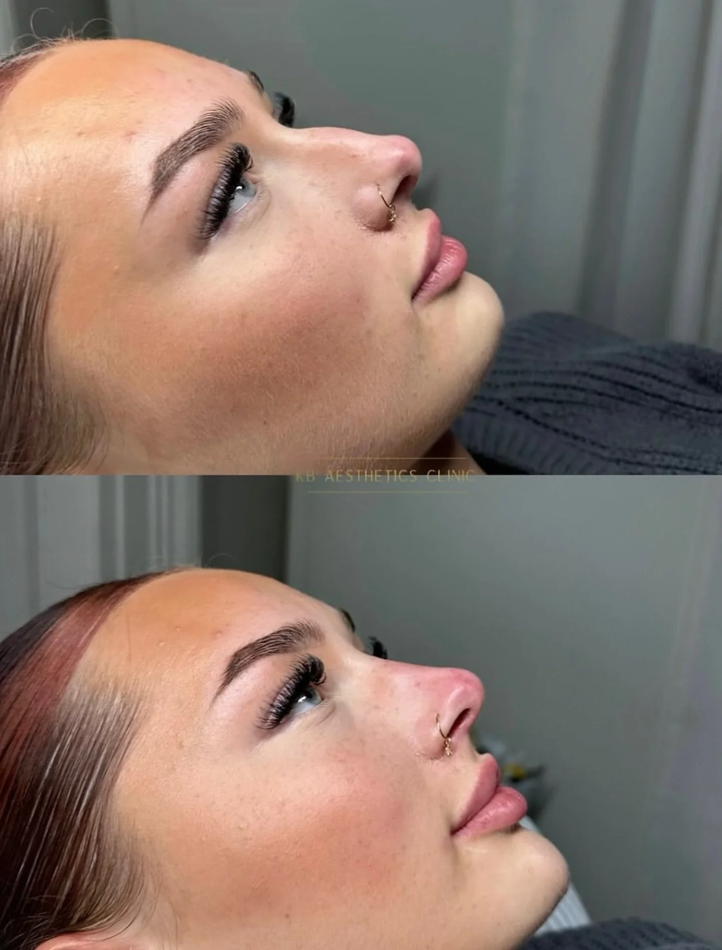 ✨ Before &amp; After ✨
Non-surgical rhinoplasty &amp; chin enhancement 💉
Just a few subtle tweaks&hellip; but the difference is everything. 🪄

No surgery. No downtime. Just beautifully refined, balanced features and natural-looking results from exp