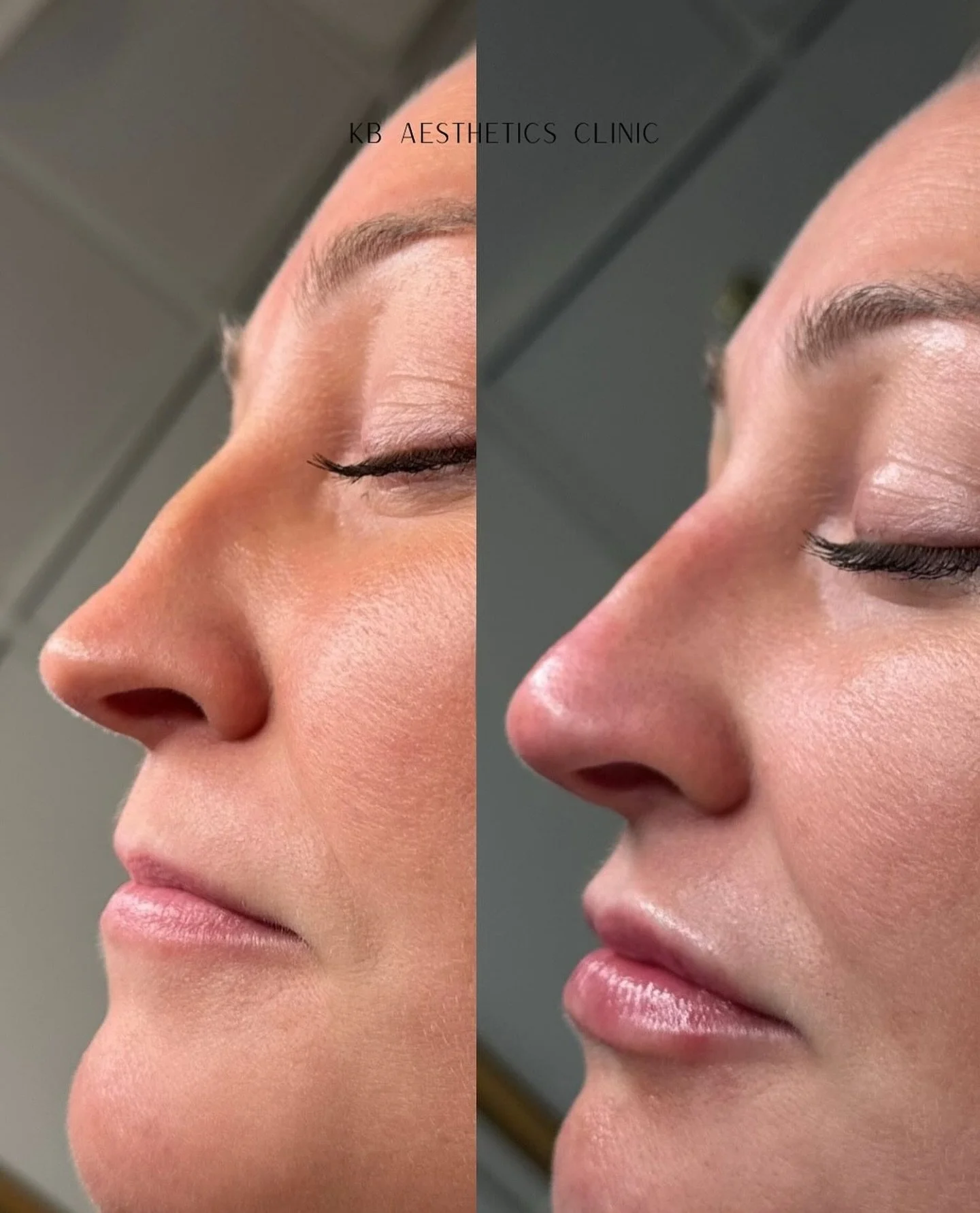 Non-surgical nose enhancement + 0.7ml lips
Soft, natural profile ✨

Treatment by @kbaestheticsclinic_ 
DM Keely directly to book 💌

#nonsurgicalrhinoplasty #nosefiller #profilebalancing #aestheticsuk #cheltenham #cheltenhamaesthetics