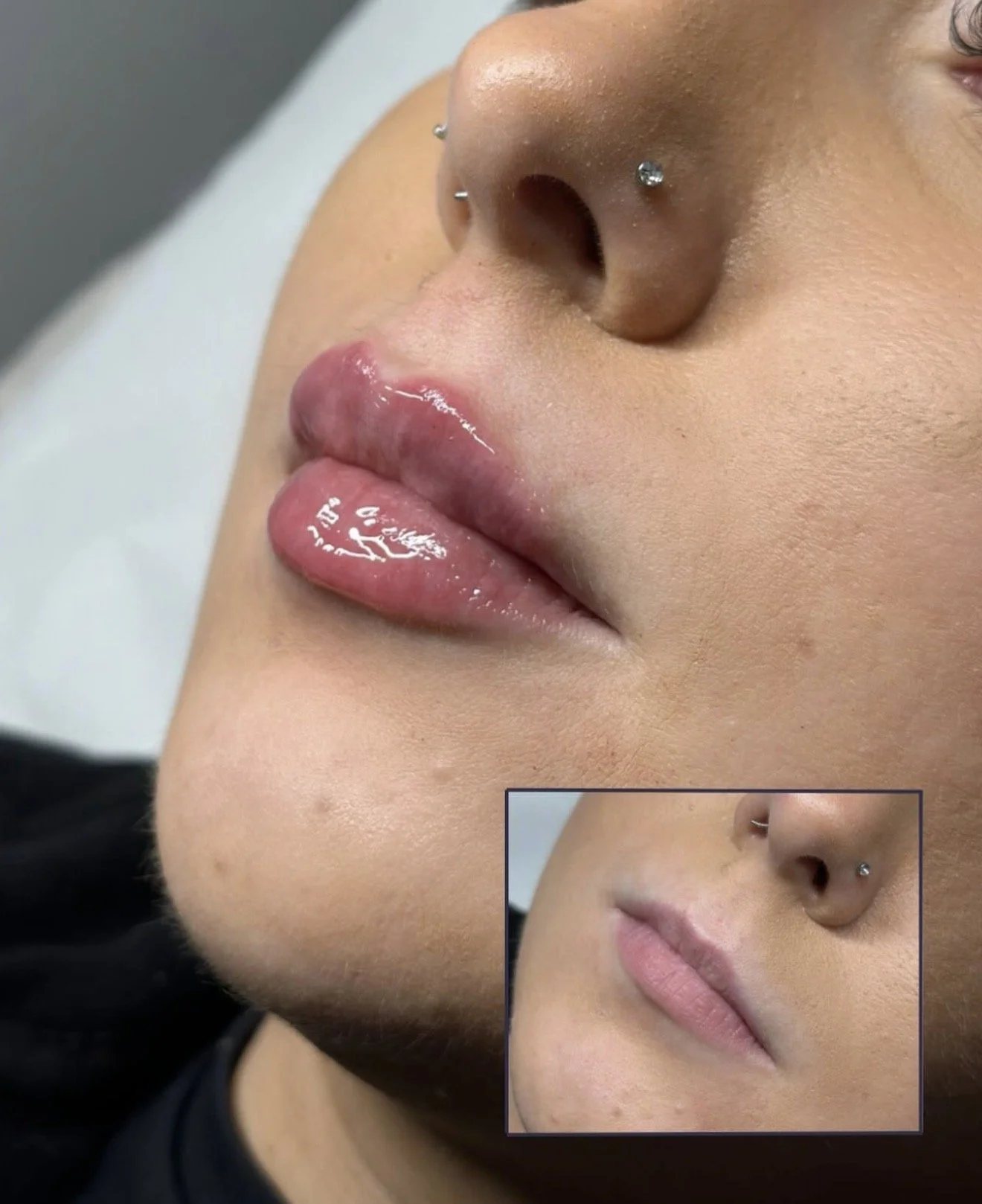 CHELTENHAM FILLER BOTOX