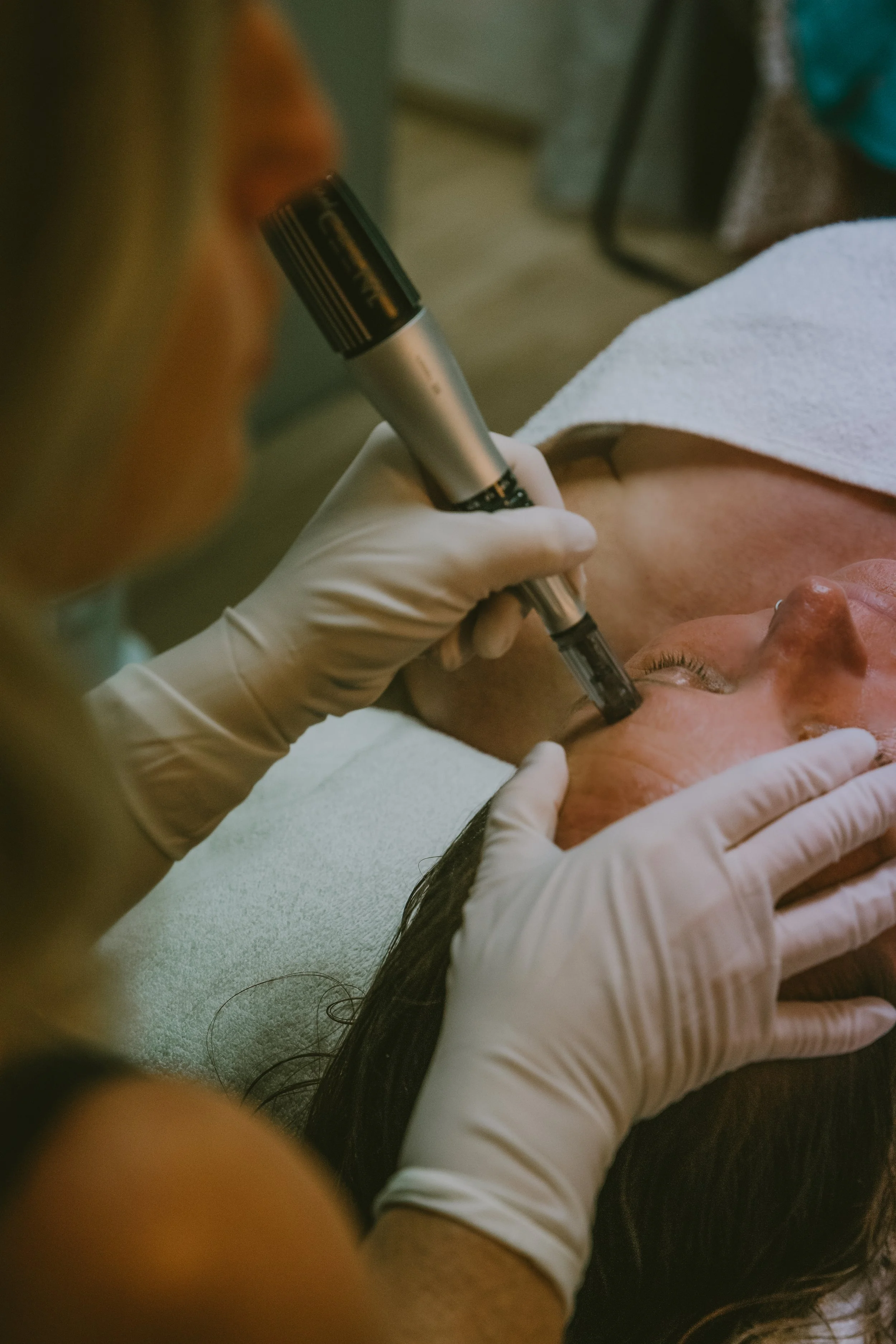 Micro-needling & Meso Therapy Stand Alone Service