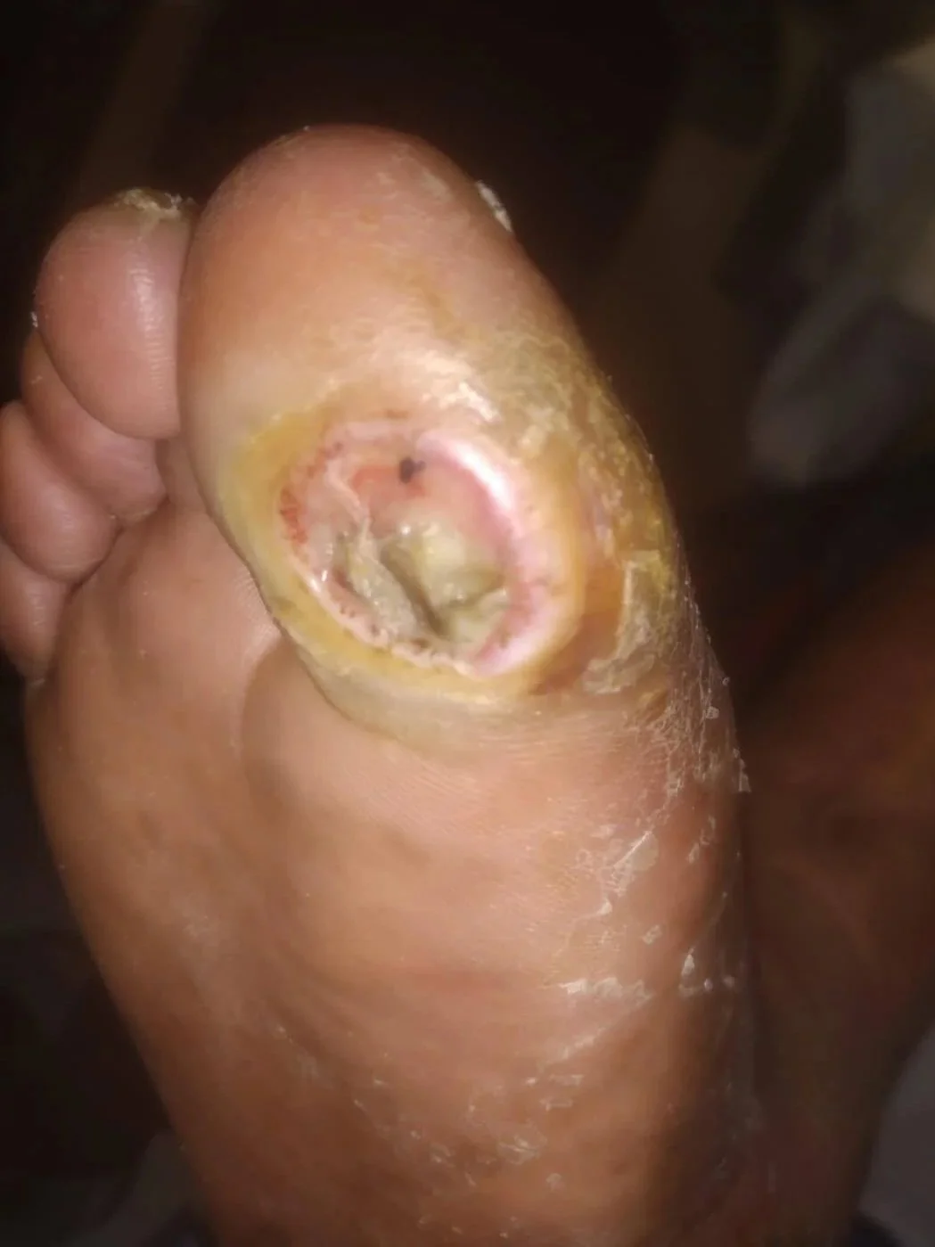 foot ulcer and wound care specialist dewitt iowa podiatrist