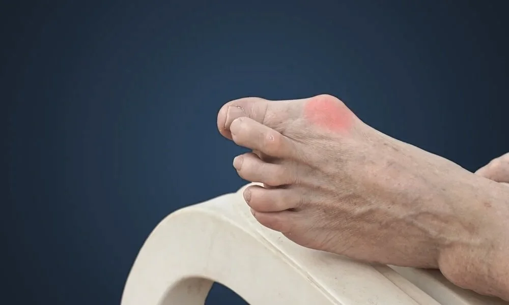 bunion treatment dewitt podiatrist