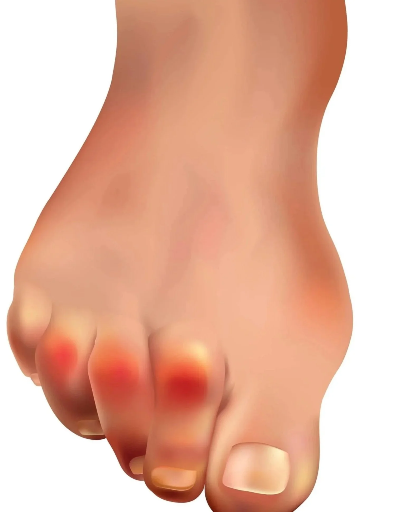 hammertoe treatment dewitt, ia podiatrist