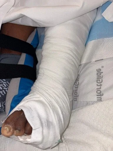 foot ulcer and wound treatment dewitt iowa podiatrist