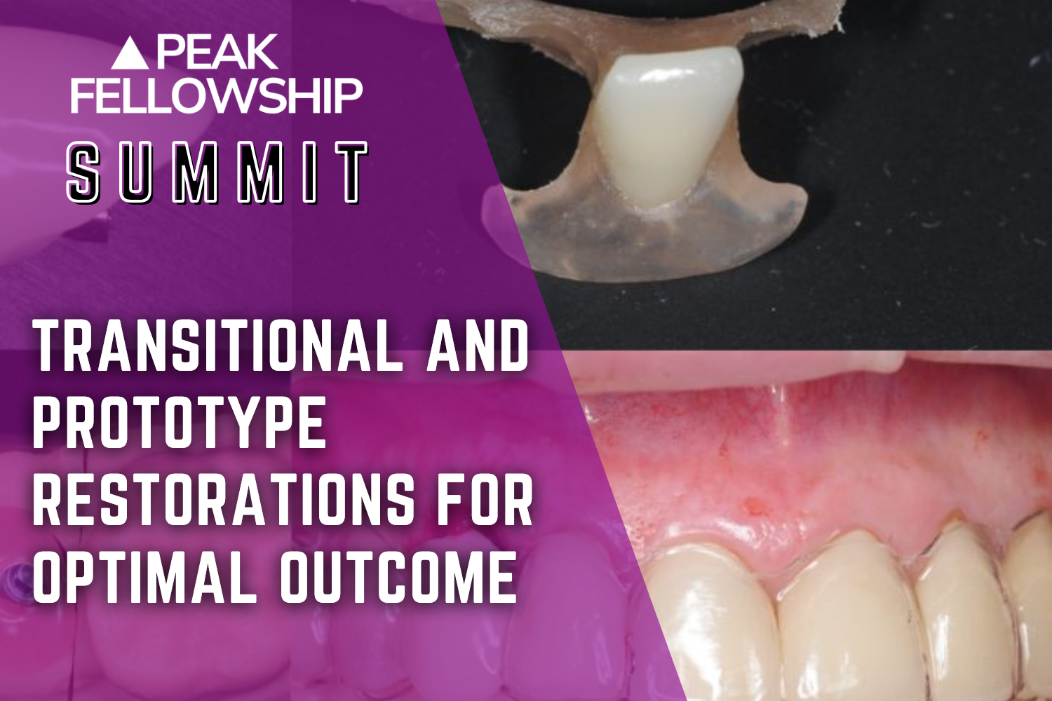 Transitional and Prototype Restorations