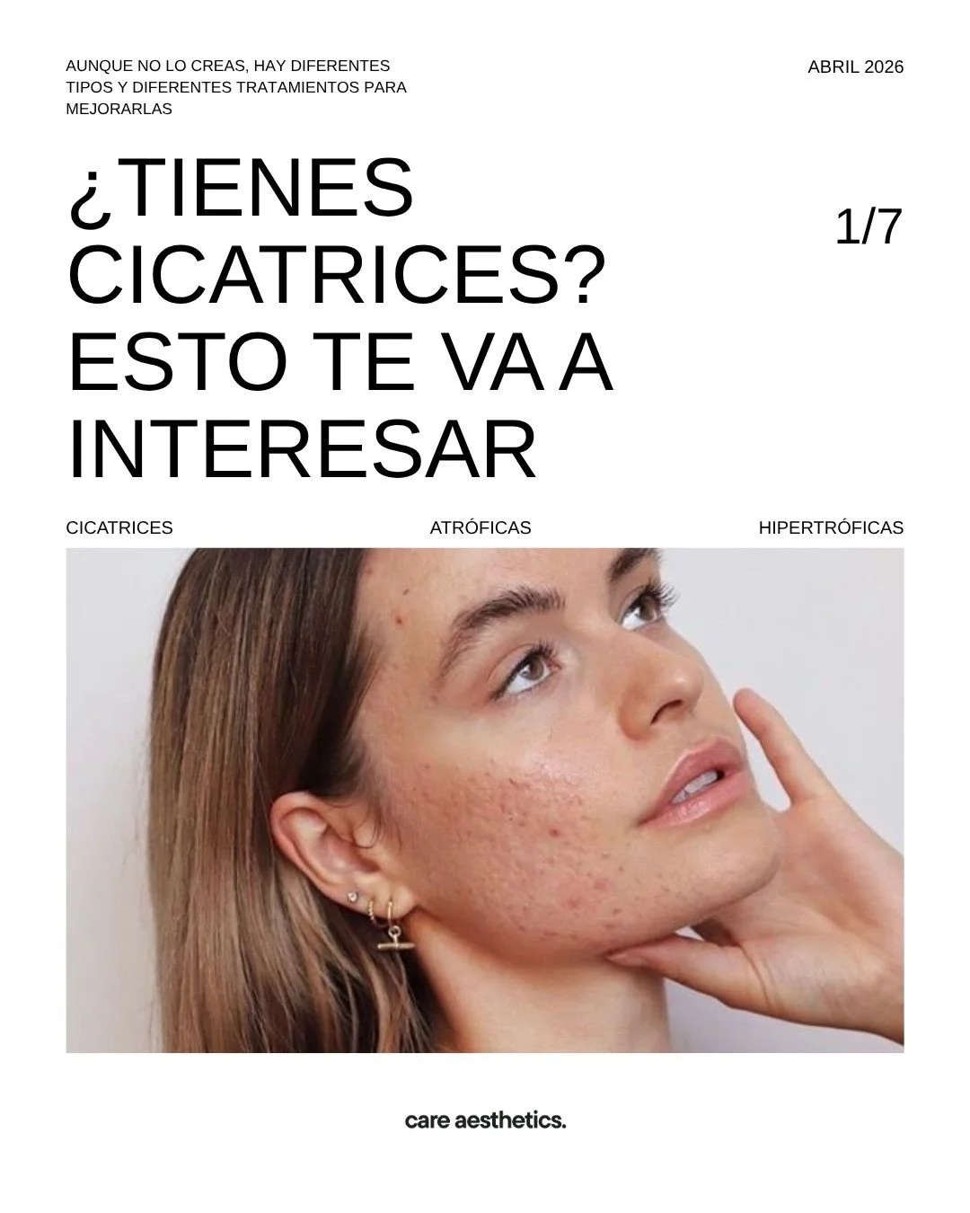 &iquest;Tuviste acn&eacute; en alg&uacute;n momento de tu vida? 🫩

Muy seguramente como much&iacute;simas personas, te quedaron cicatrices como secuela post-acn&eacute;😕

Existen excelentes opciones de tratamiento para mejorarlas 🙂. Uno de ellos e