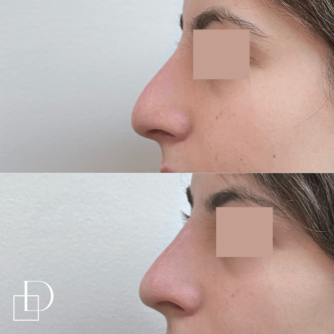 Before and after non-surgical rhinoplasty nose filler at Define Clinic Brisbane