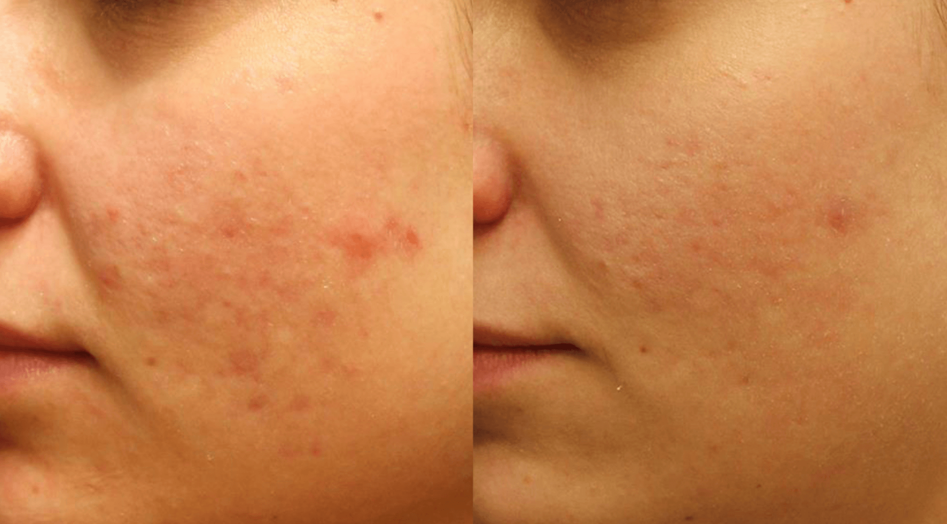 Before and after acne treatment with Laser Genesis at Define Clinic Brisbane