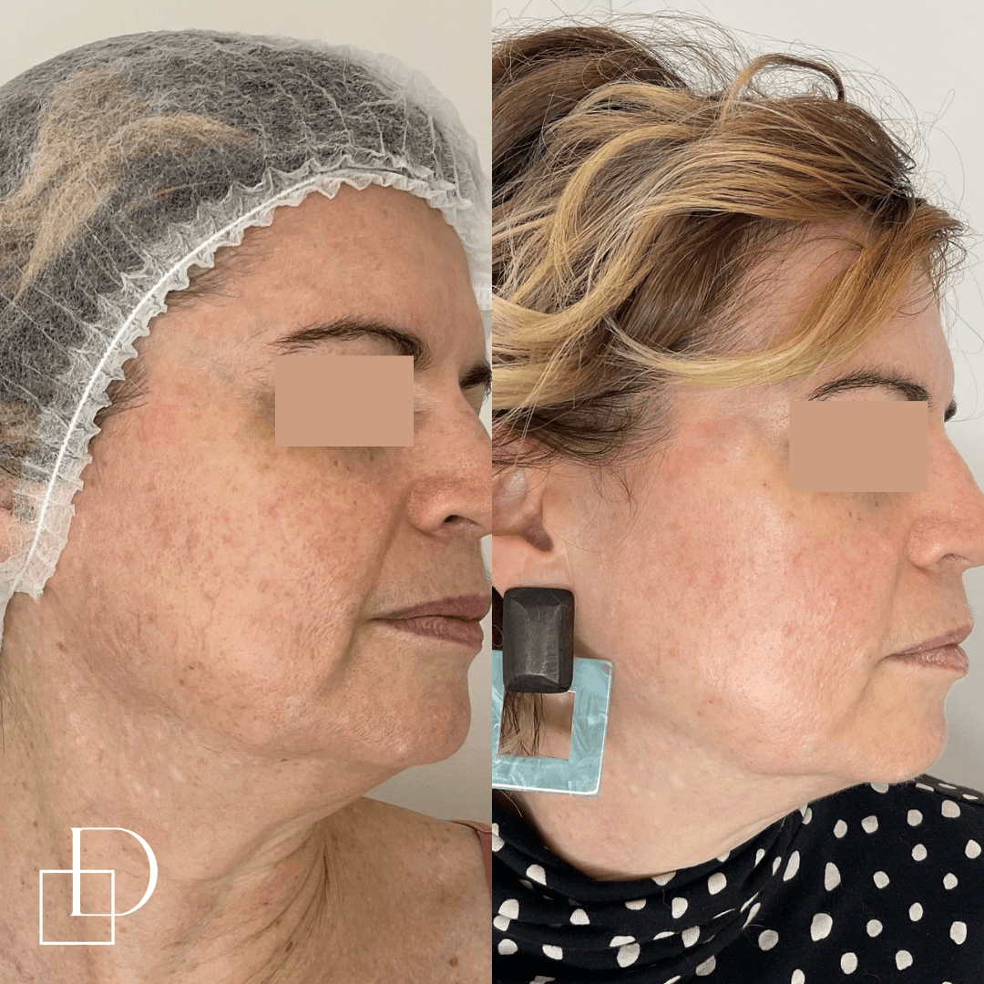 Before and after treatment with Laser Genesis at Define Clinic Brisbane