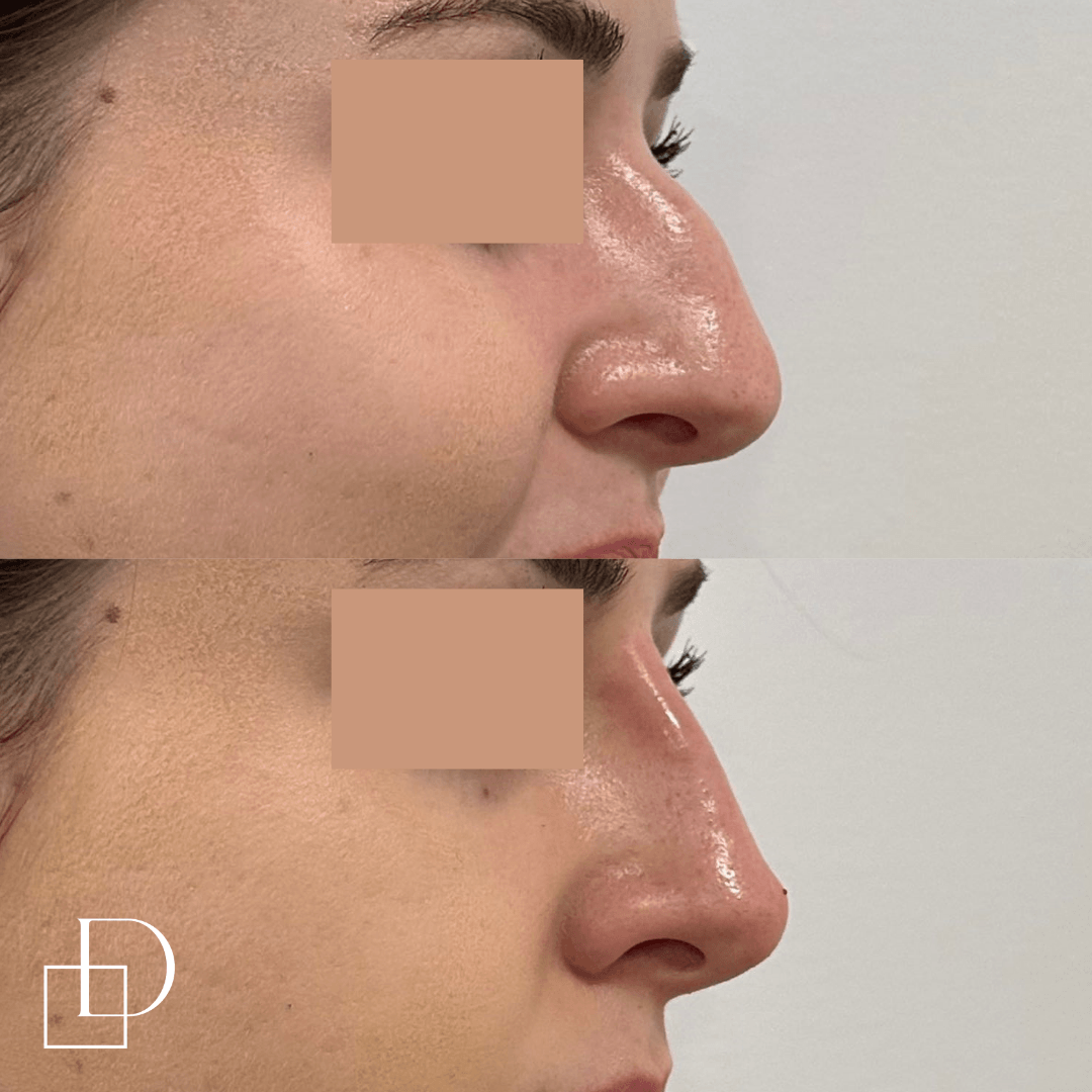 Before and after non-surgical rhinoplasty nose filler at Define Clinic Brisbane