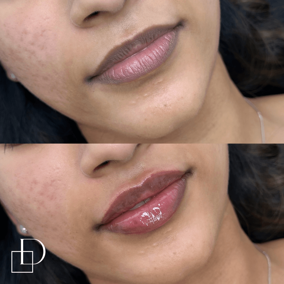 Before and after lip filler injections at Define Clinic Brisbane