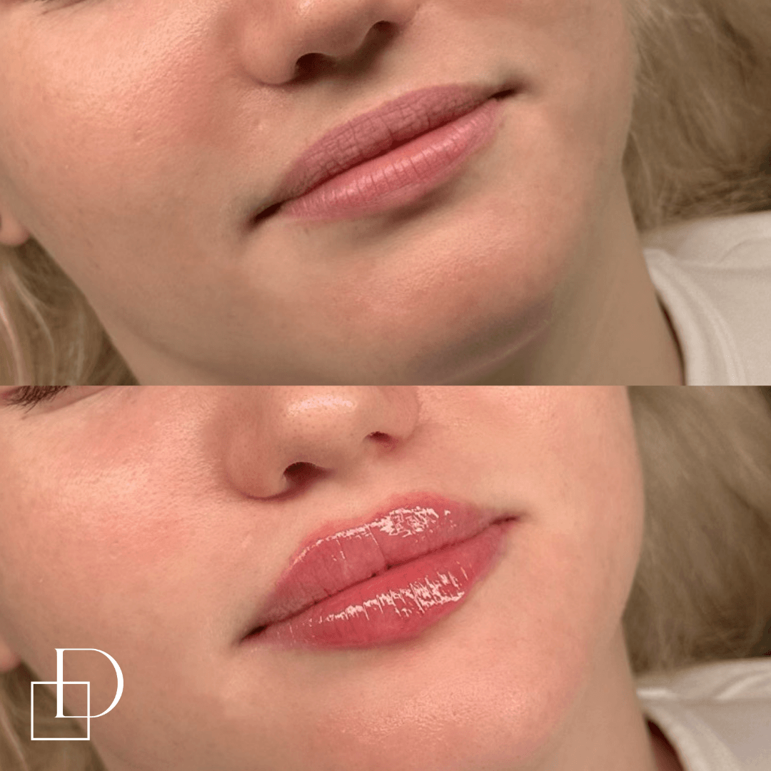 Before and after lip filler injections at Define Clinic Brisbane