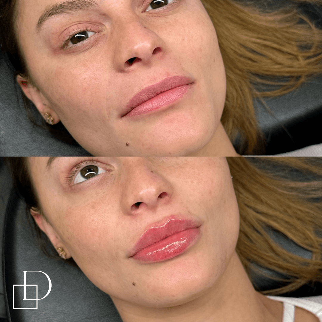Before and after lip filler injections at Define Clinic Brisbane
