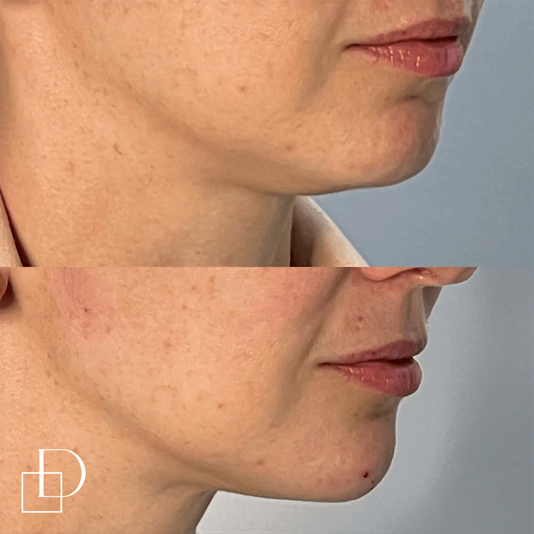 Before and after chin filler injections at Define Clinic Brisbane