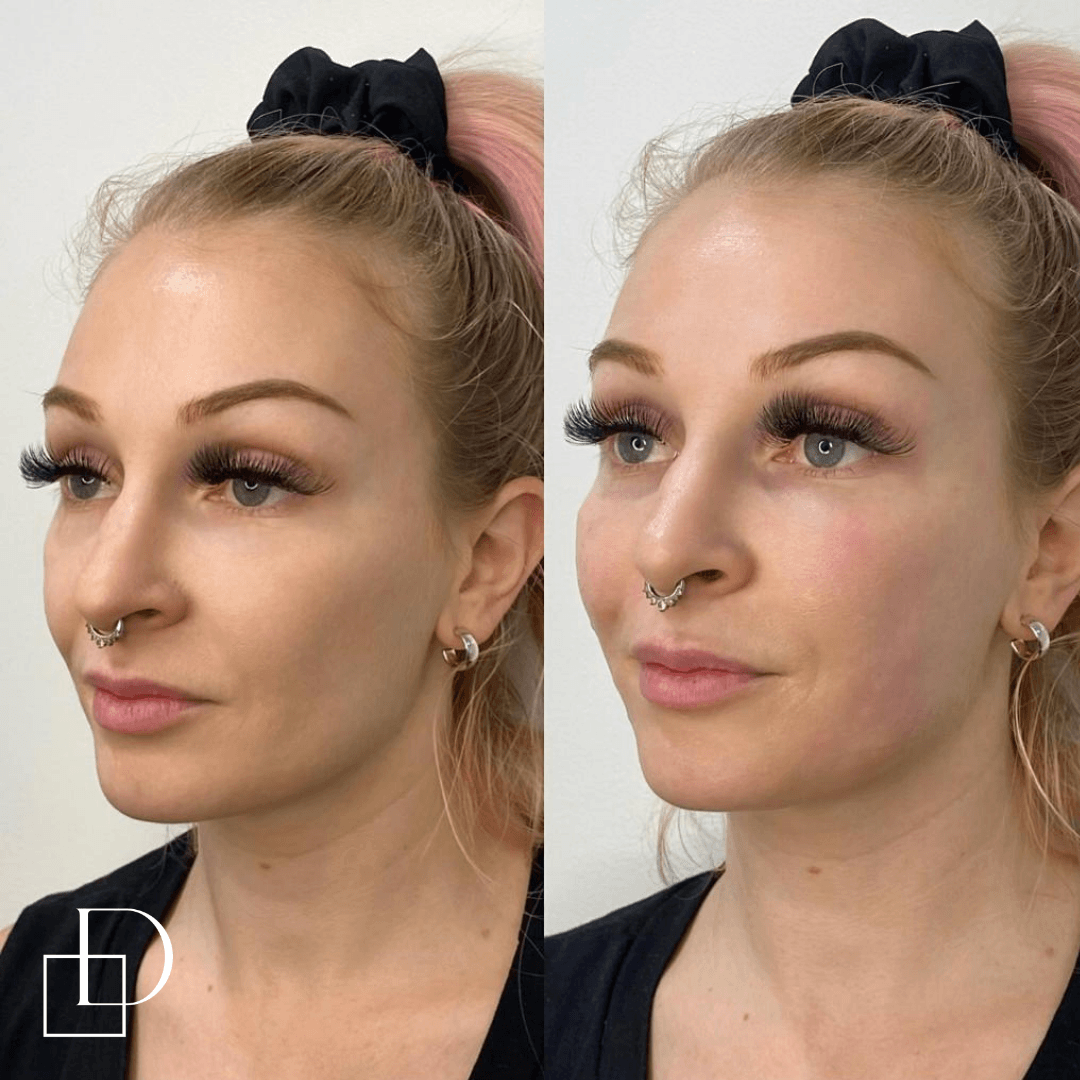 Before and after cheek filler injections at Define Clinic Brisbane