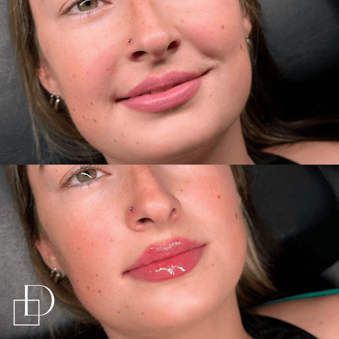 Before and after lip filler injections at Define Clinic Brisbane