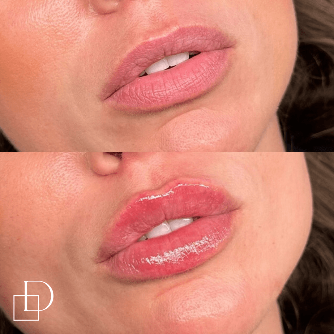 Before and after lip filler injections at Define Clinic Brisbane