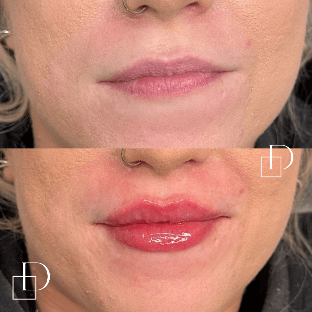 Before and after lip filler injections at Define Clinic Brisbane