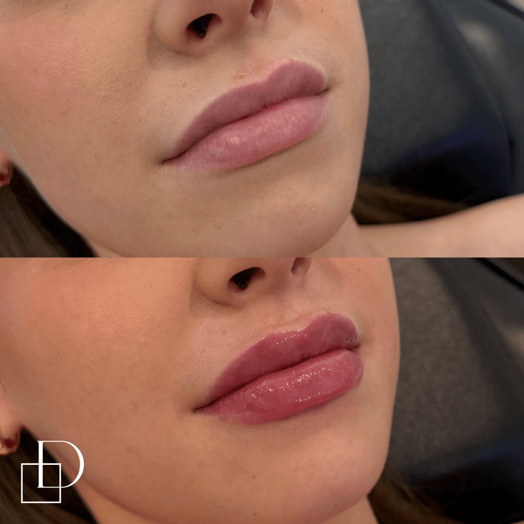 Before and after lip filler injections at Define Clinic Brisbane