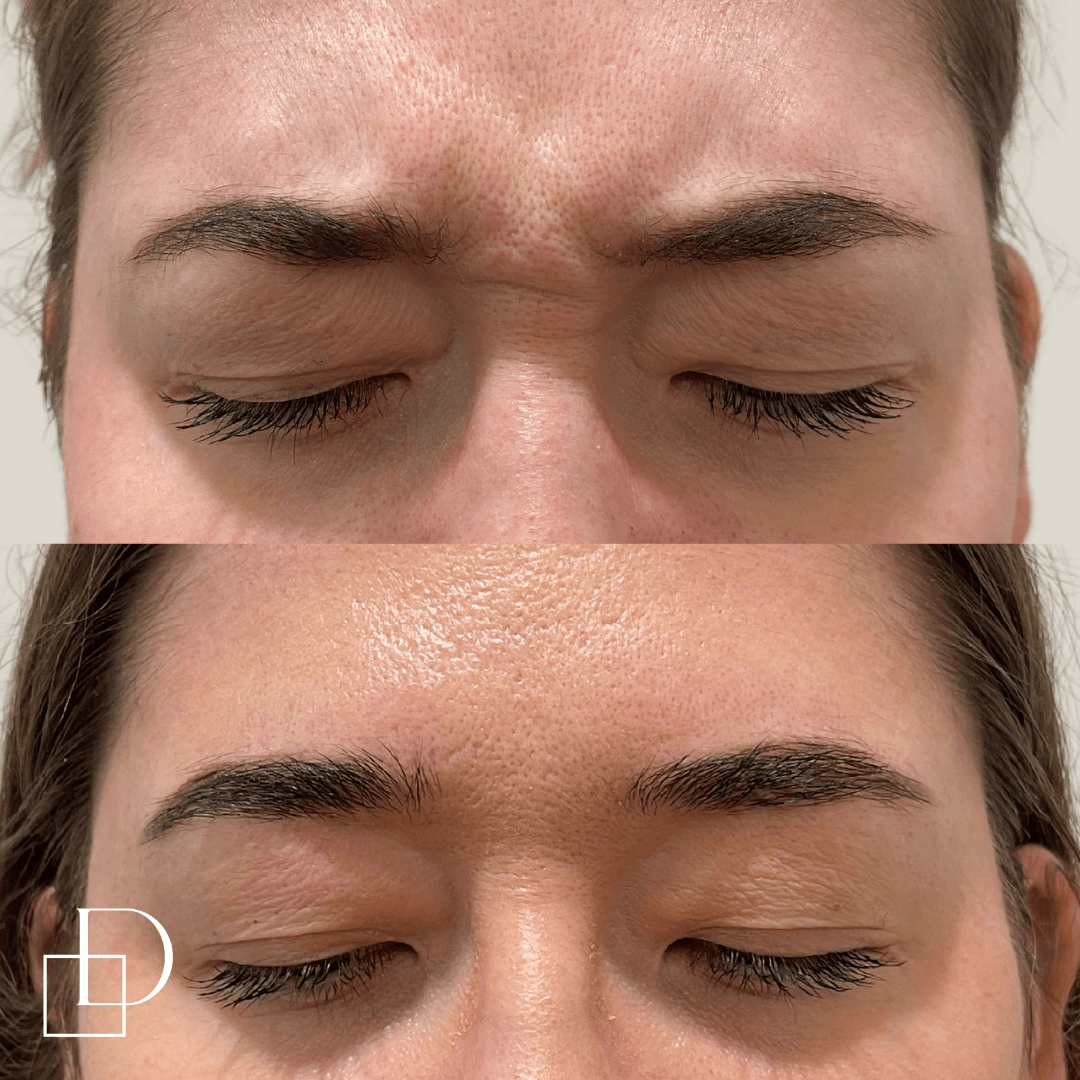 Before and after frown botox anti-wrinkle at Define Clinic Brisbane