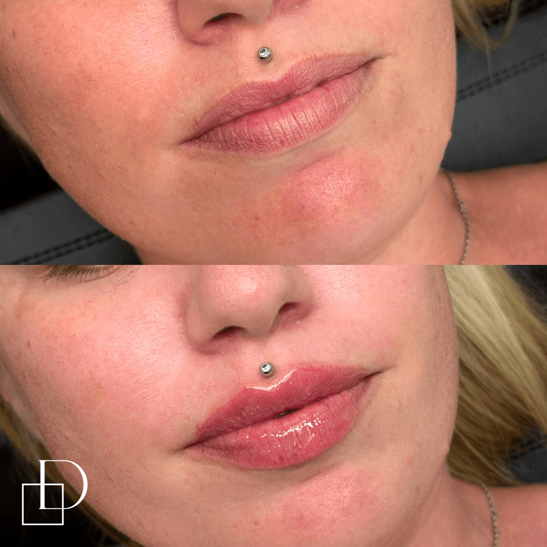 Before and after lip filler injections at Define Clinic Brisbane
