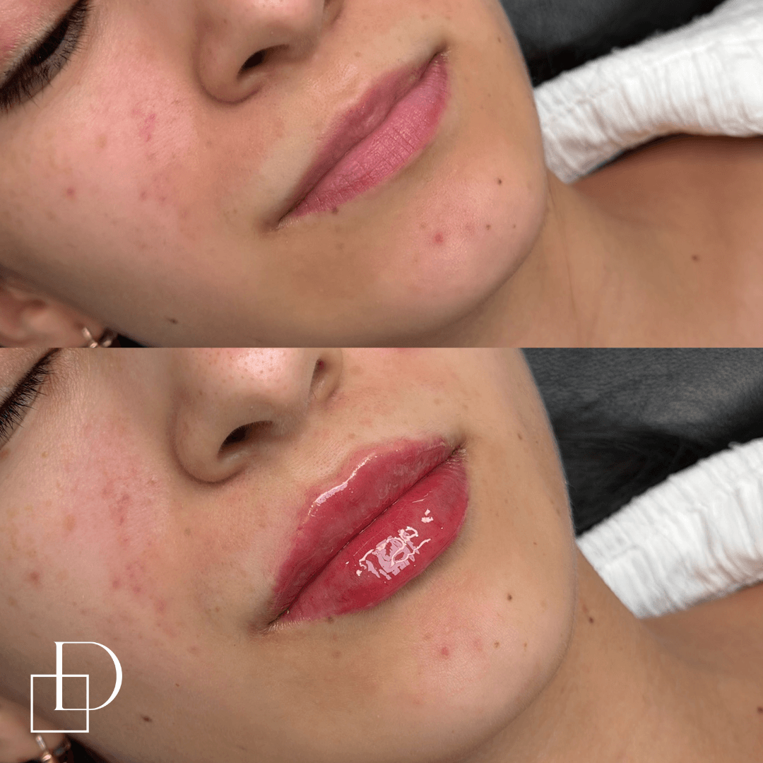 Before and after lip filler injections at Define Clinic Brisbane