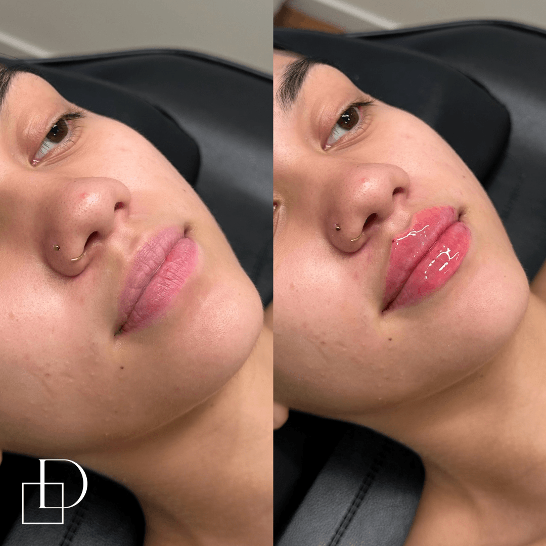 Before and after lip filler injections at Define Clinic Brisbane