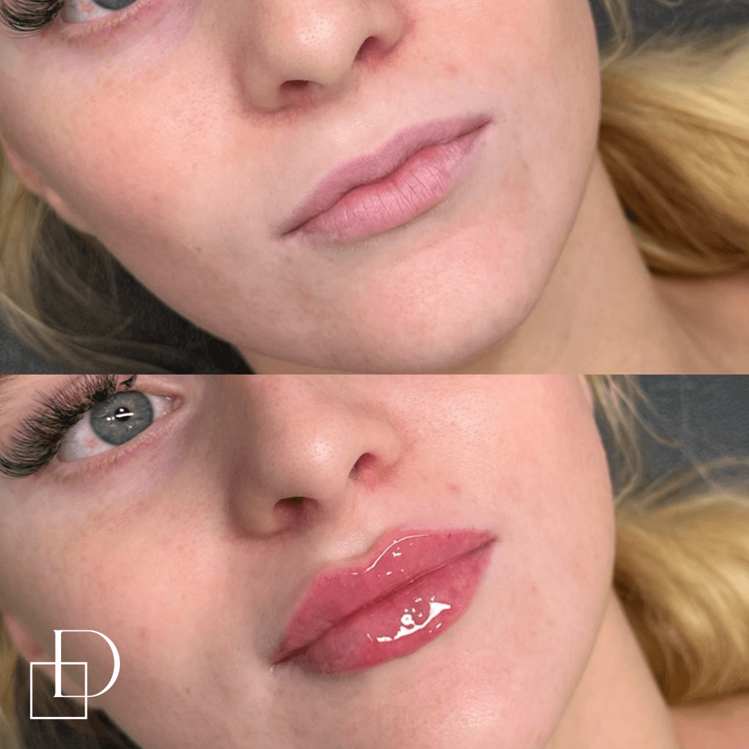 Before and after lip filler injections at Define Clinic Brisbane