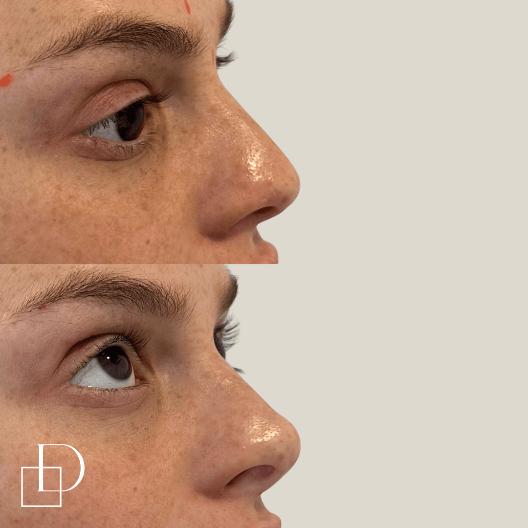 Before and after non-surgical rhinoplasty nose filler at Define Clinic Brisbane