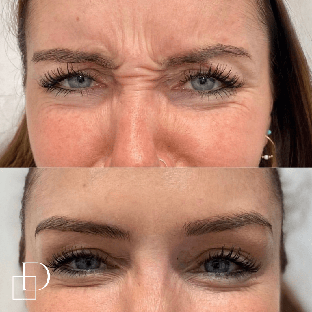 Before and after frown botox anti-wrinkle at Define Clinic Brisbane