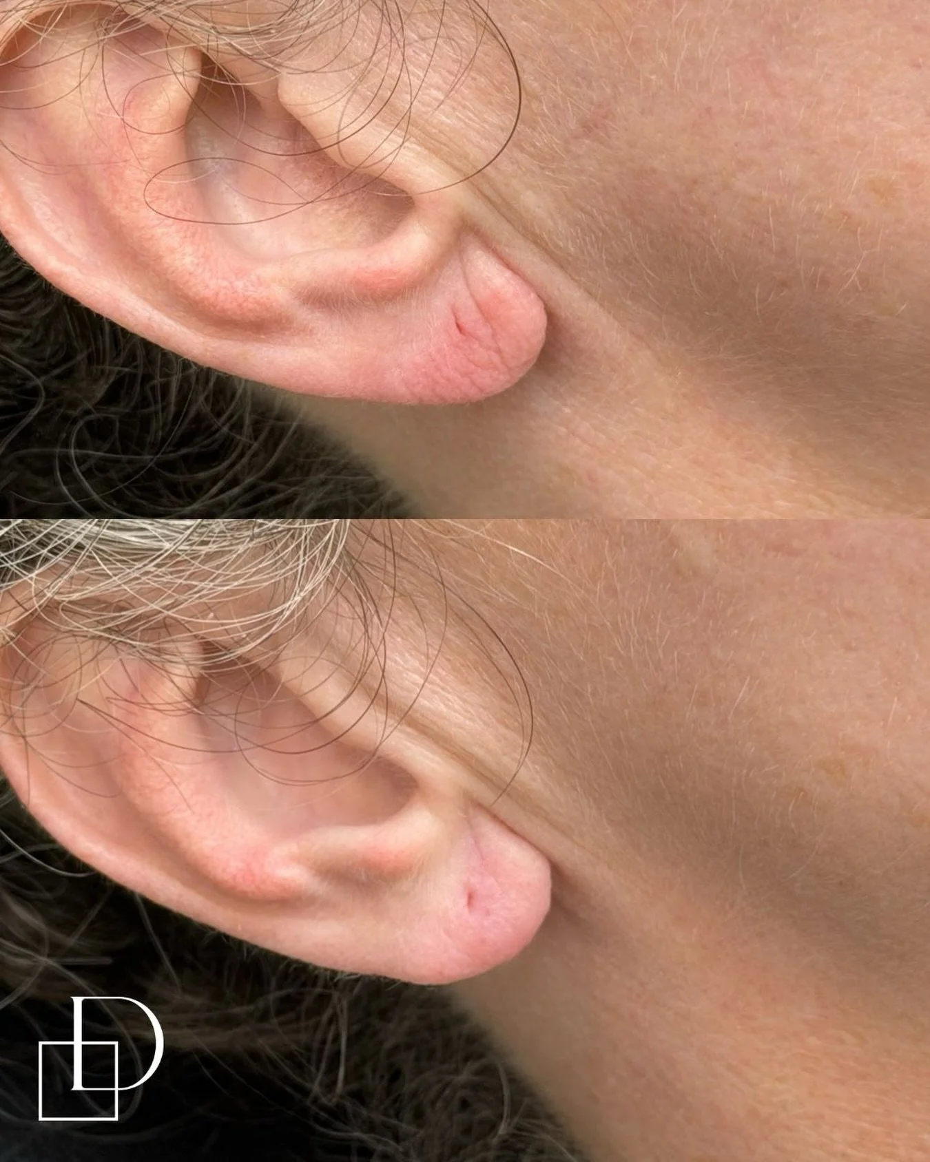 Treatment by Nurse An

If you&rsquo;d like to know more please send us a DM. Alternatively, you can book online for a complimentary consultation with one of our skilled practitioners to discuss cosmetic medicine treatment options and prices.

Outcome