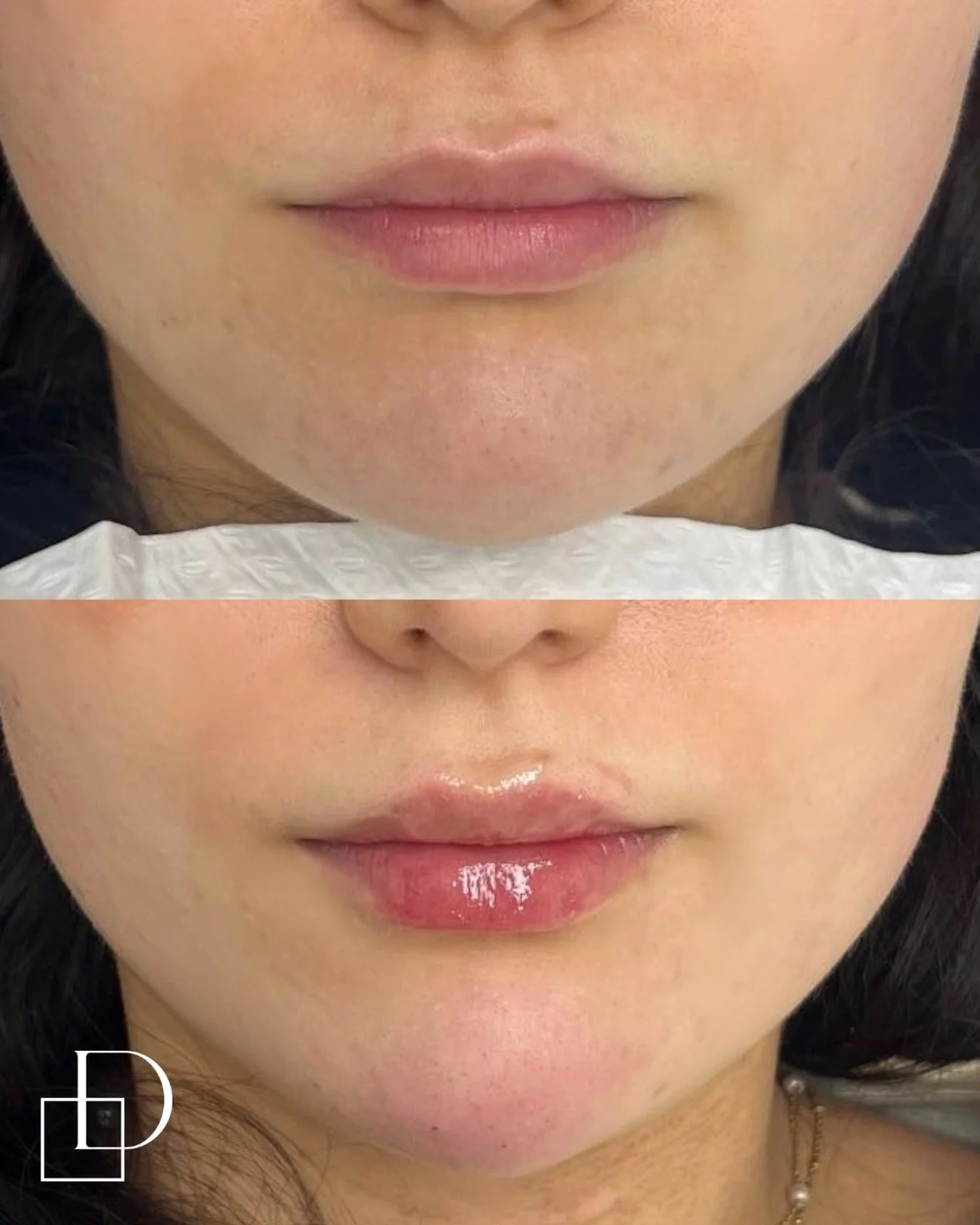 Treatment by Nurse Nancy

If you&rsquo;d like to know more please send us a DM. Alternatively, you can book online for a complimentary consultation with one of our skilled practitioners to discuss cosmetic medicine treatment options and prices.

Outc