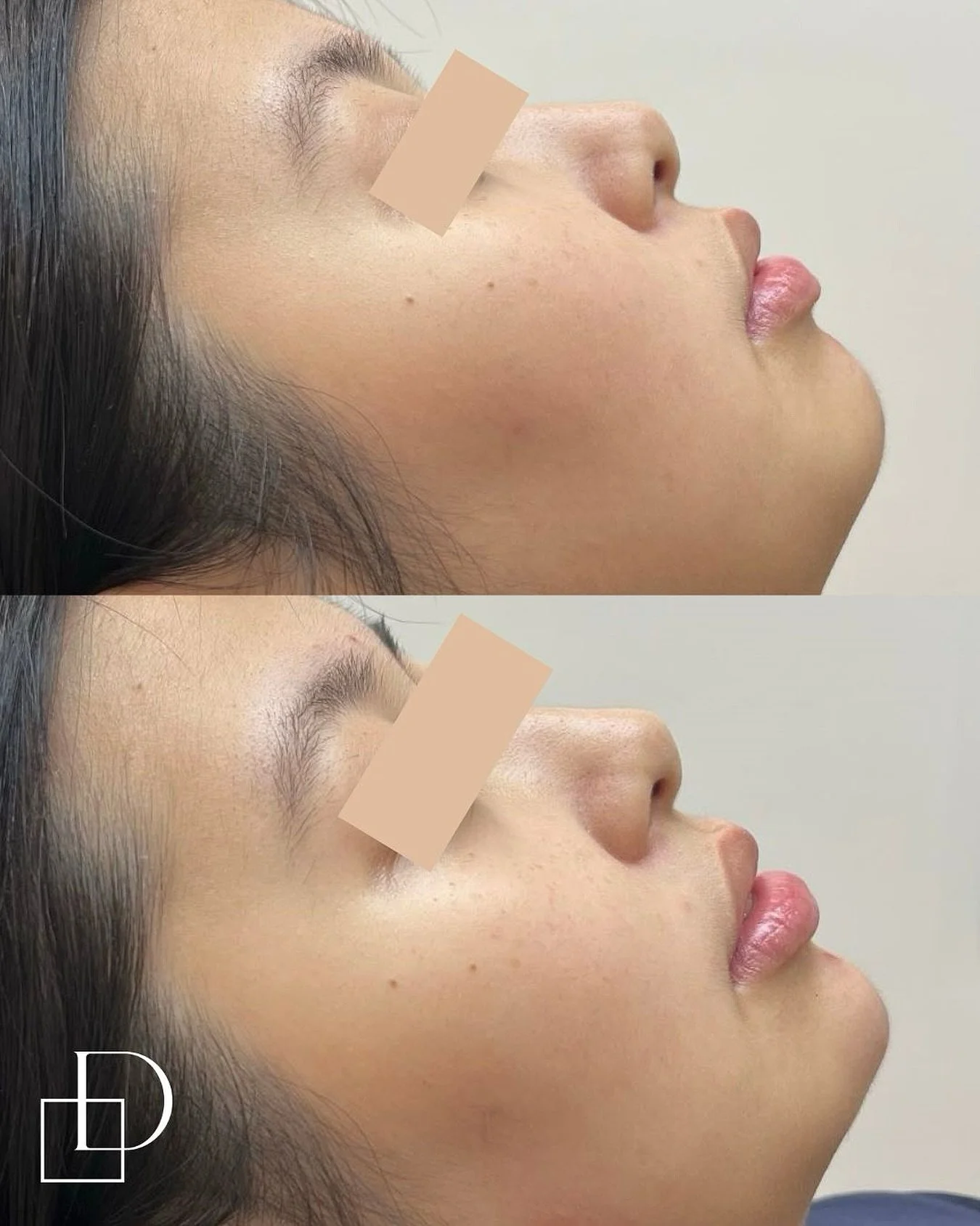Treatment by Nurse Nancy

If you&rsquo;d like to know more please send us a DM. Alternatively, you can book online for a complimentary consultation with one of our skilled practitioners to discuss cosmetic medicine treatment options and prices.

Outc