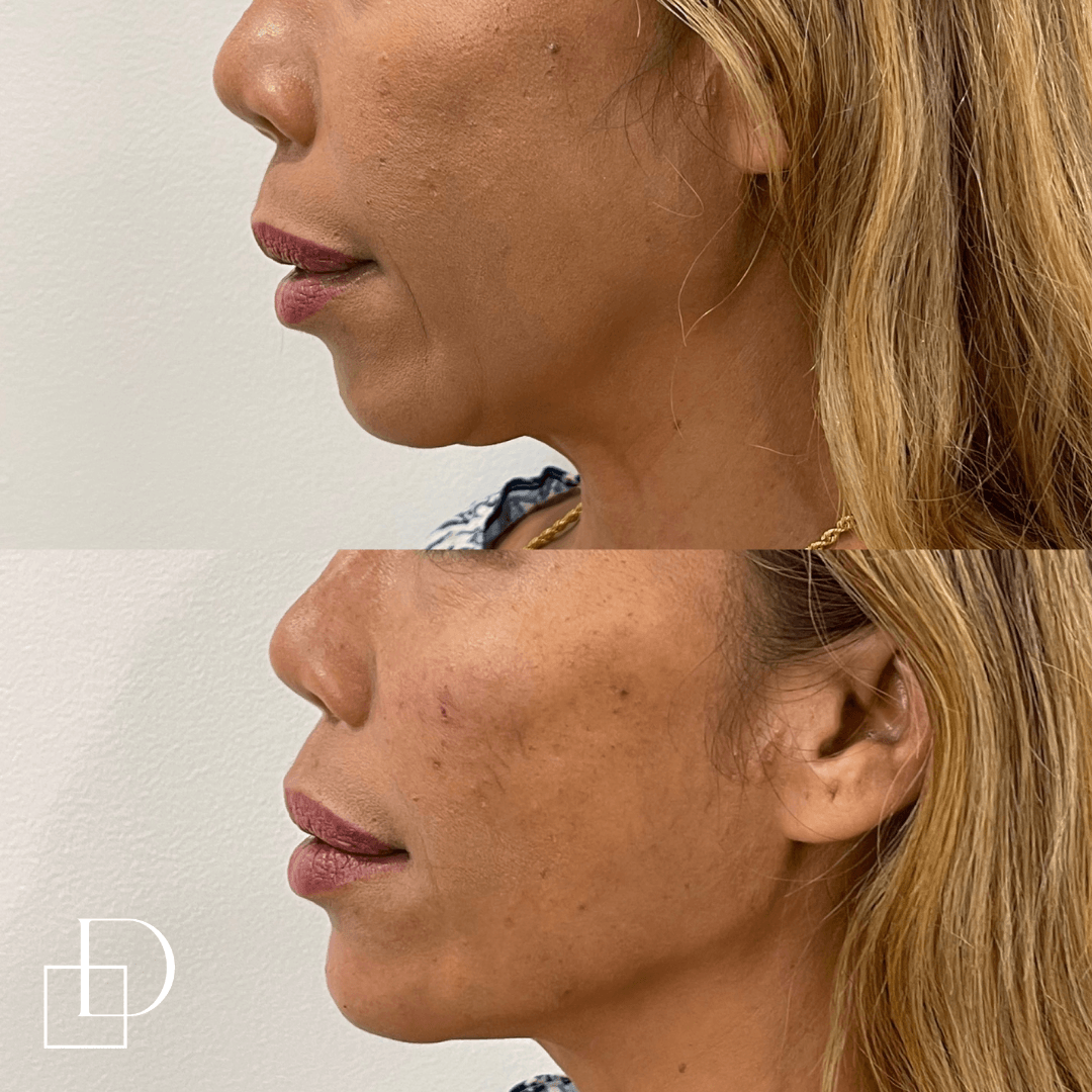 Before and after jawline filler injections at Define Clinic Brisbane