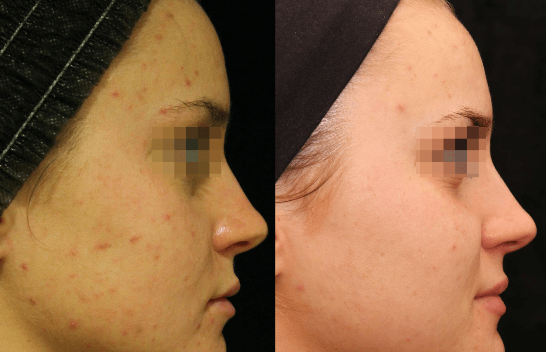 Before and after acne treatment with Laser Genesis at Define Clinic Brisbane