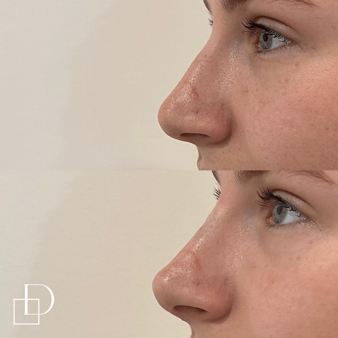 Before and after non-surgical rhinoplasty nose filler at Define Clinic Brisbane