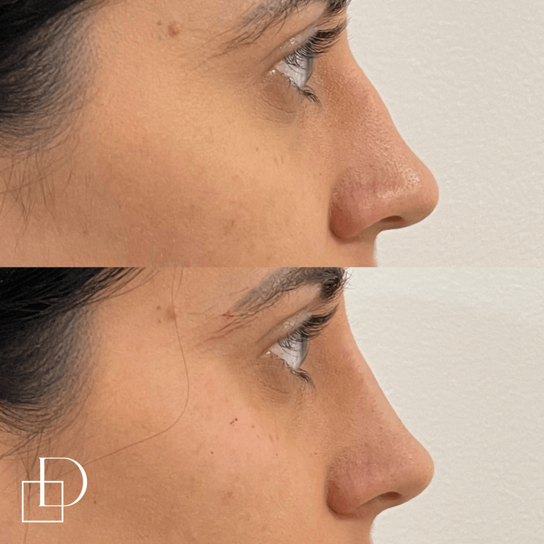 Before and after non-surgical rhinoplasty nose filler at Define Clinic Brisbane